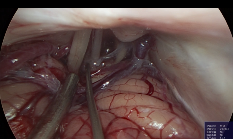 神经外科垂体瘤手术