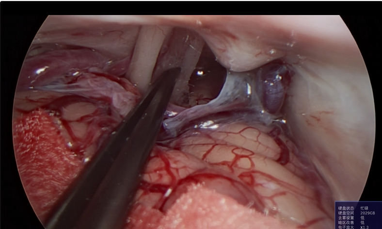 神经外科垂体瘤手术