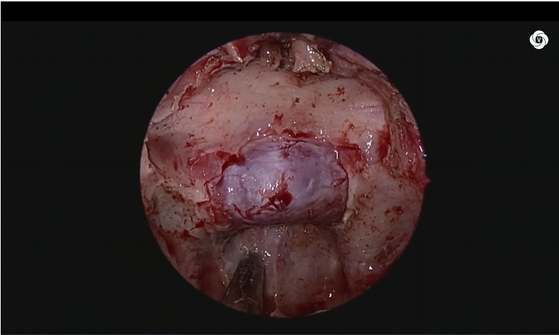 神经外科垂体瘤手术