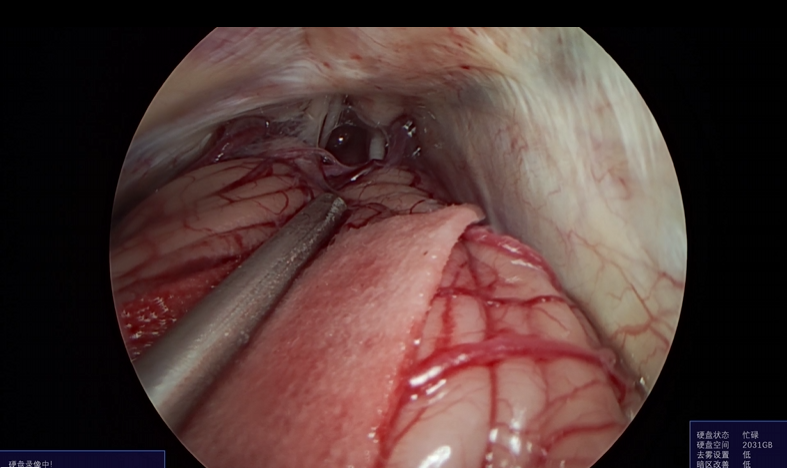 神经外科垂体瘤手术