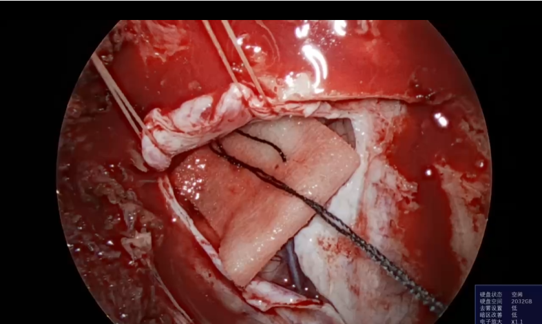 神经外科垂体瘤手术