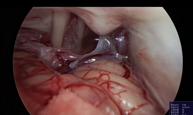 神经外科垂体瘤手术