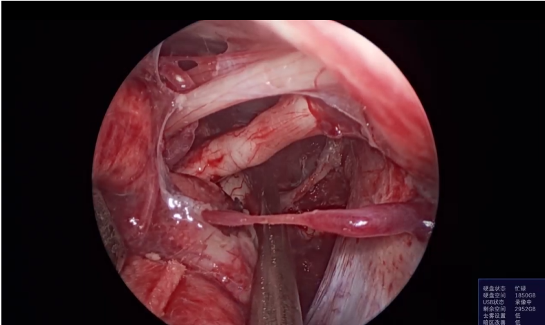 浙江大学大二附属医院-垂体瘤手术吴群主任