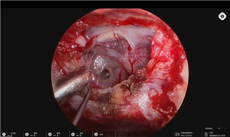 神经外科垂体瘤手术