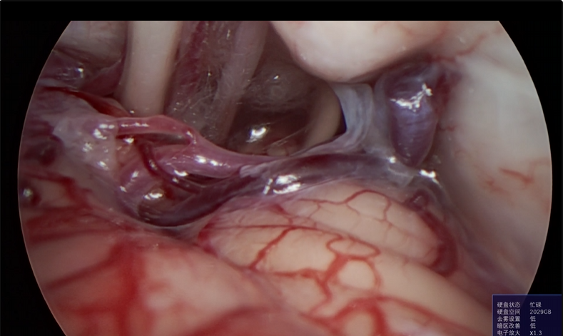 神经外科垂体瘤手术