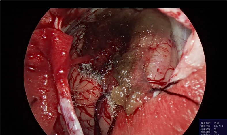 神经外科垂体瘤手术